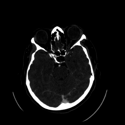 Aplasia of the internal carotid artery (Radiopaedia 61082-68960 A 25).jpg