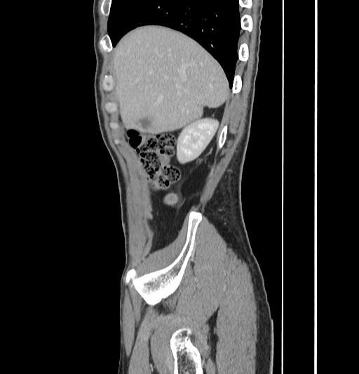 Appendiceal mucinous adenocarcinoma (Radiopaedia 66605-75922 C 10).jpg