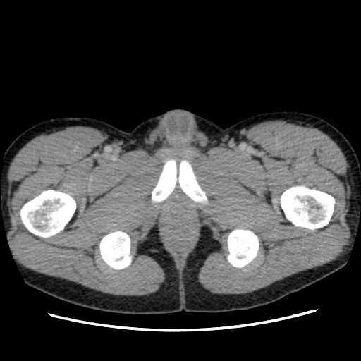 File:Appendicitis complicated by post-operative collection (Radiopaedia 35595-37114 A 92).jpg