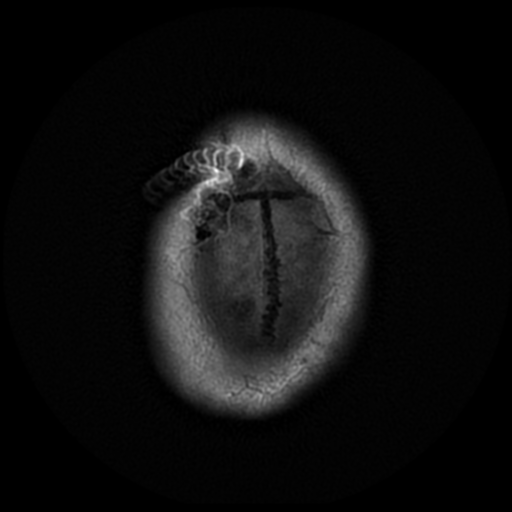 File:Aqueduct stenosis due to web (Radiopaedia 42207-45273 Axial FLAIR 24).png