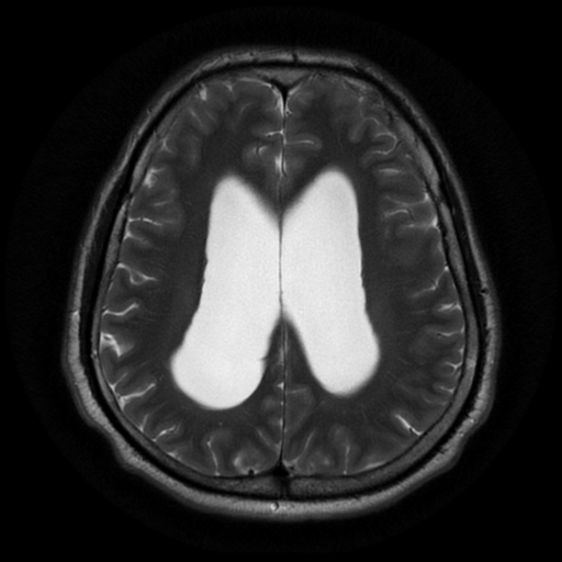 File:Aqueduct stenosis with corpus callosum hypoattenuation post shunting (Radiopaedia 37212-38969 Axial T2 15).png