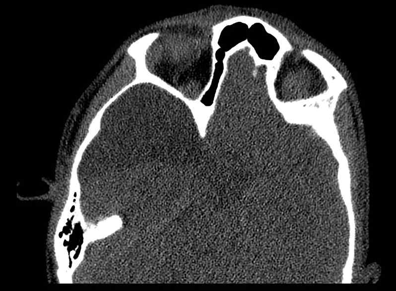 File:Arachnoid cyst- extremely large (Radiopaedia 68741-78450 Axial bone window 34).jpg
