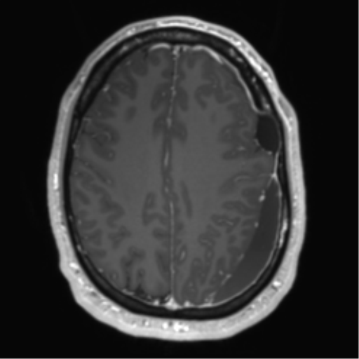 Arachnoid cyst with subdural hematoma (Radiopaedia 85892-101743 Axial T1 C+ 60).png