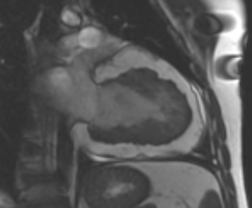Arrhythmogenic right ventricular cardiomyopathy (Radiopaedia 69431-79307 2ch cine 29).jpg