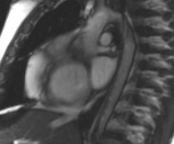 File:Arrhythmogenic right ventricular cardiomyopathy (Radiopaedia 69431-79307 Short axis cine 242).jpg