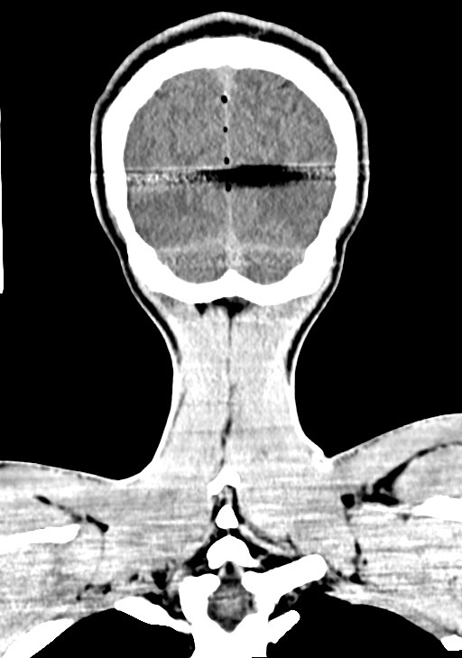 Arrow injury to the brain (Radiopaedia 72101-82607 Coronal non-contrast 63).jpg