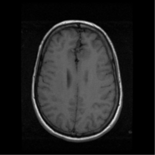 File:Arteriovenous malformation (cerebral) (Radiopaedia 40070-42580 Axial T1 15).png
