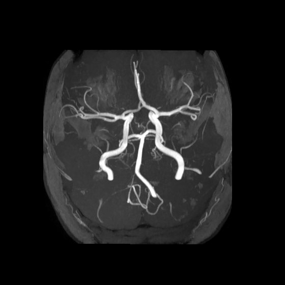 Artery of Percheron infarct (Radiopaedia 40966-43676 F 15).jpg