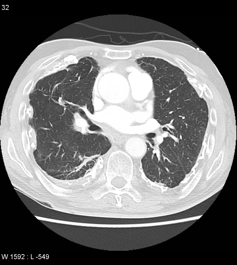 Asbestos related lung and pleural disease (Radiopaedia 14377-14301 A 29).jpg