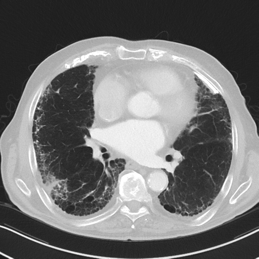 File:Asbestosis (Radiopaedia 56192-62864 Axial lung window 37).png