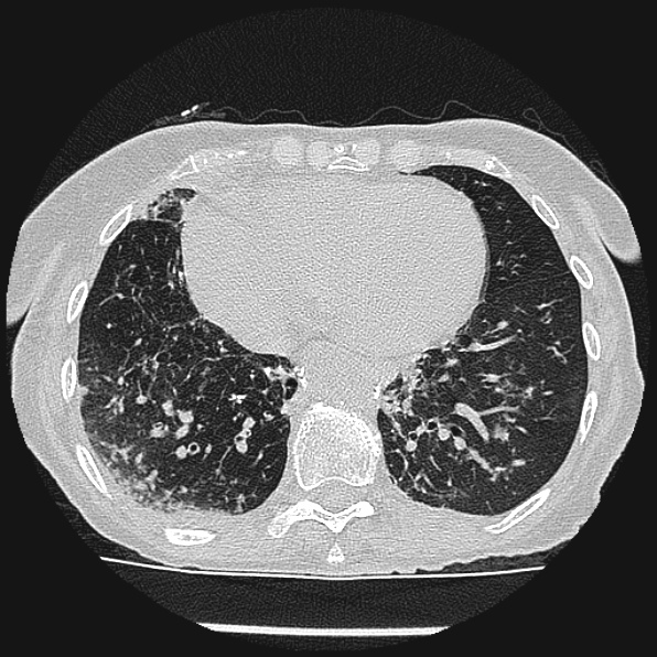 Aspergilloma (Radiopaedia 24458-24763 Axial lung window 50).jpg
