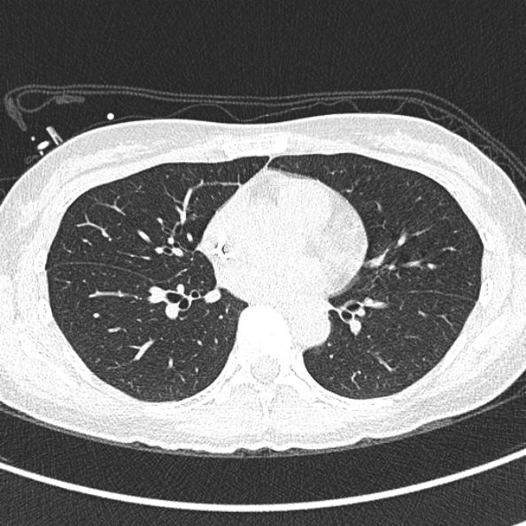 Aspergilloma (Radiopaedia 26223-26347 Axial lung window 43).jpg