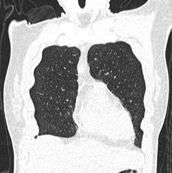 File:Aspergilloma (Radiopaedia 26223-26347 Coronal lung window 11).jpg