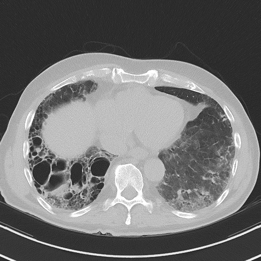Aspergilloma on background pulmonary fibrosis (Radiopaedia 60942-68757 A 41).jpg