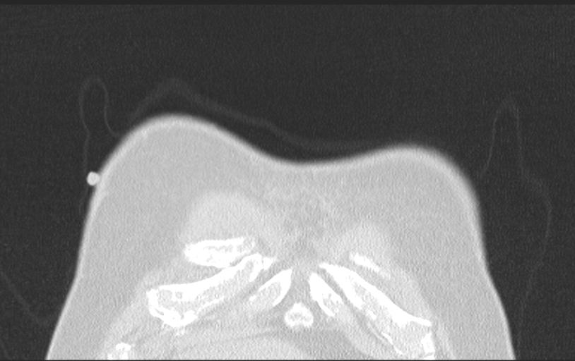 Aspirated tooth (Radiopaedia 28584-28844 Axial lung window 19).jpg