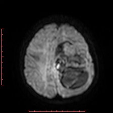 Astroblastoma (Radiopaedia 74287-85162 Axial DWI 77).jpg