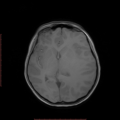 File:Astroblastoma (Radiopaedia 74287-85162 Axial T1 11).jpg