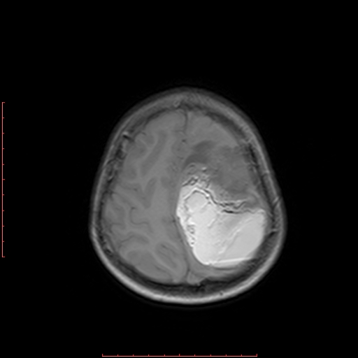 File:Astroblastoma (Radiopaedia 74287-85162 Axial T1 19).jpg