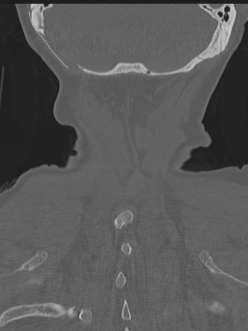 Atlanto-axial subluxation (Radiopaedia 36610-38176 Coronal bone window 47).png