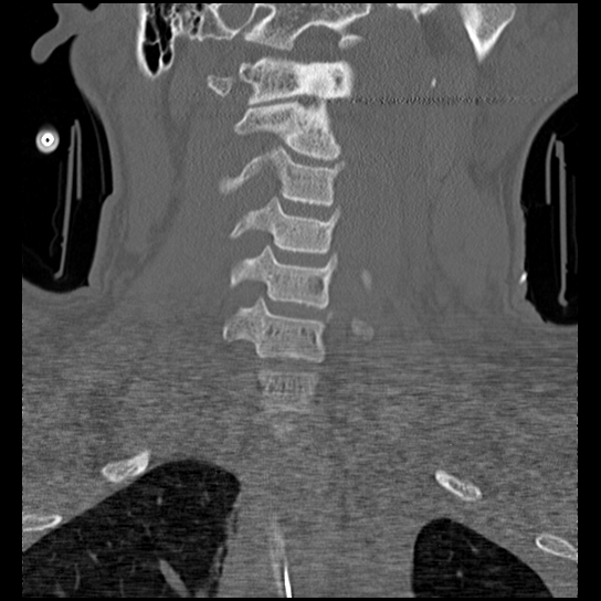 Atlanto-occipital dissociation injury (Radiopaedia 29274-29698 Coronal bone window 30).png