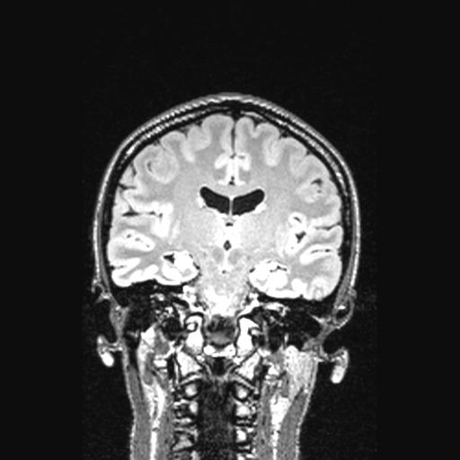 File:Atretic encephalocoele with inferior vermis hypoplasia (Radiopaedia 30443-31108 Coronal FLAIR 90).jpg