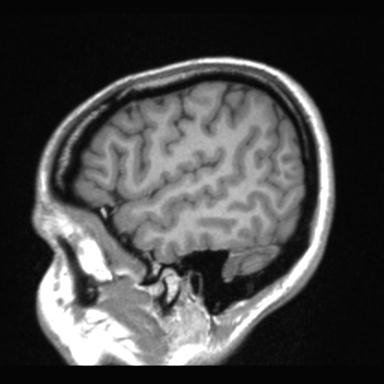 Atretic encephalocoele with inferior vermis hypoplasia (Radiopaedia 30443-31108 Sagittal T1 19).jpg