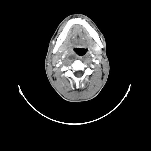 File:Atypical 2nd branchial cleft cyst (type IV) - infected (Radiopaedia 20986-20924 A 11).jpg