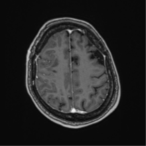 Atypical meningioma (WHO Grade II) (Radiopaedia 54742-60981 Axial T1 C+ 54).png