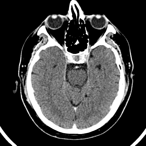 Atypical meningioma (WHO grade II) with brain invasion (Radiopaedia 57767-64728 Axial C+ 37).png