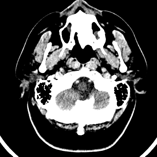 Atypical meningioma (WHO grade II) with brain invasion (Radiopaedia 57767-64728 Axial C+ 51).png