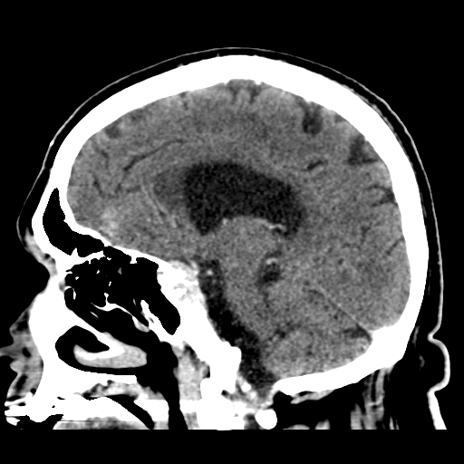 Atypical meningioma (WHO grade II) with brain invasion (Radiopaedia 57767-64728 Sagittal C+ 30).png