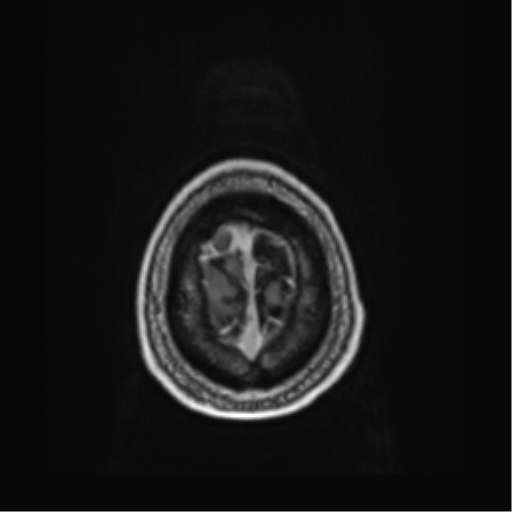 Atypical meningioma (WHO grade II) with brain invasion (Radiopaedia 57767-64729 Axial T1 C+ 48).png