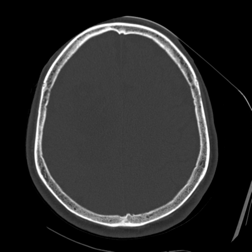File:Atypical meningioma with skull invasion (Radiopaedia 34357-35649 Axial bone window 58).png