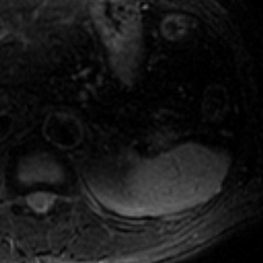 File:Atypical renal cyst on MRI (Radiopaedia 17349-17046 Axial T2 fat sat 1).jpg