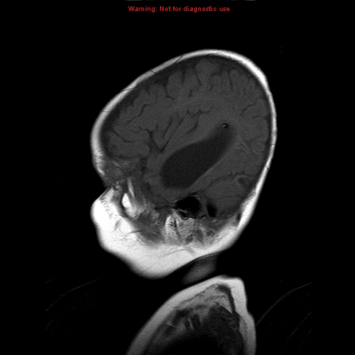 File:Atypical teratoid rhabdoid tumor (Radiopaedia 10712-11183 Sagittal T1 4).jpg