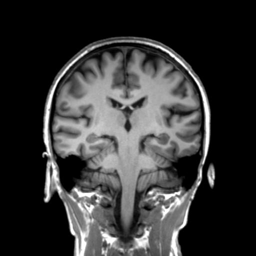 Autoimmune limbic encephalitis (Radiopaedia 30363-31005 Coronal T1 26).jpg