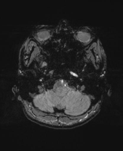 Autoimmune limbic encephalitis (Radiopaedia 30363-31005 SWI - magnitude 12).jpg