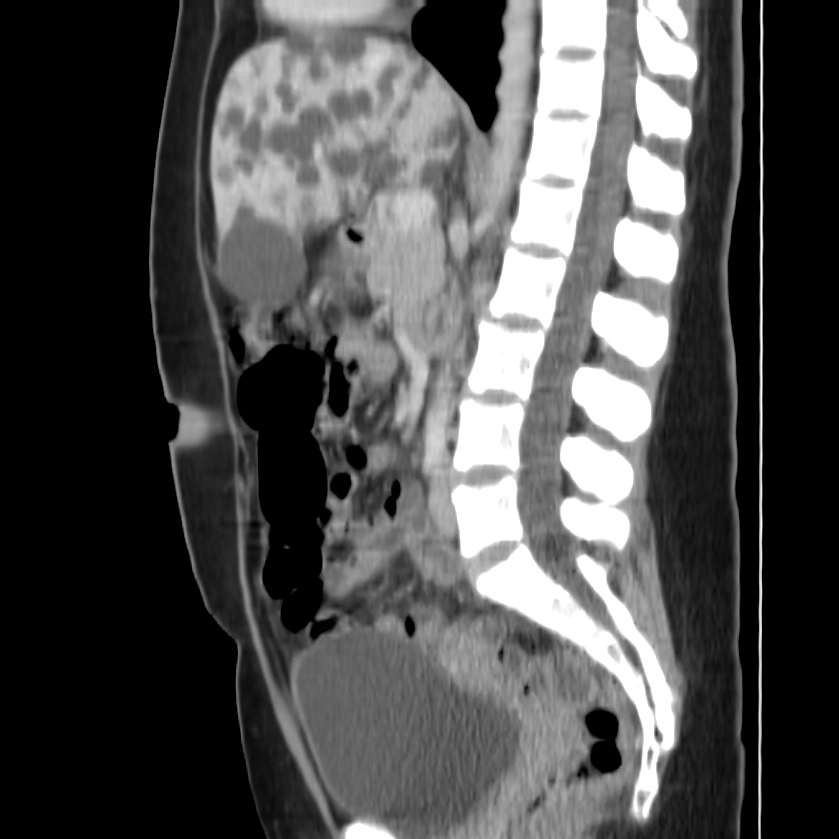 Autosomal dominant polycystic kidney disease (Radiopaedia 23061-23093 F 28).jpg