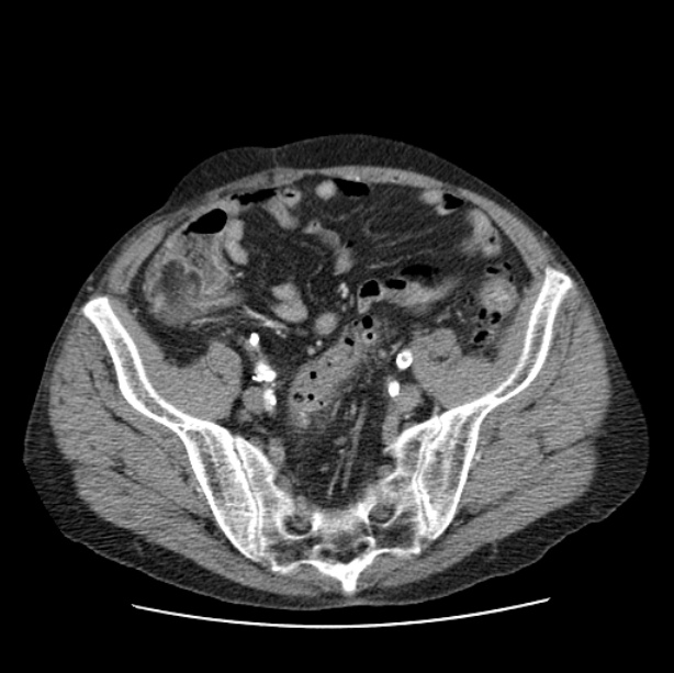 Autosomal dominant polycystic kidney disease (Radiopaedia 27851-28094 B 100).jpg