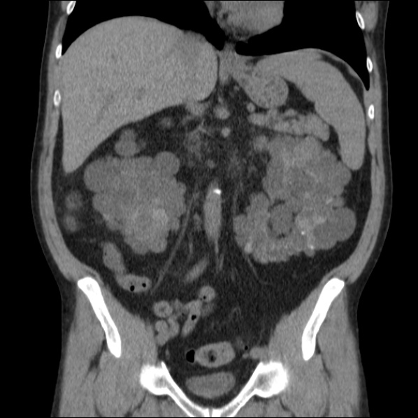 File:Autosomal dominant polycystic kidney disease (Radiopaedia 36539-38101 C 34).jpg