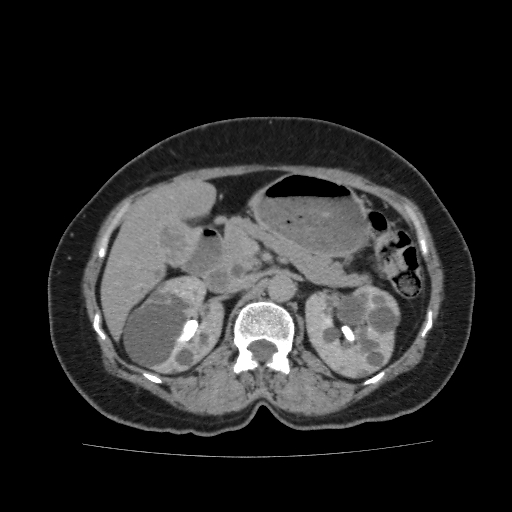 Autosomal dominant polycystic kidney disease (Radiopaedia 38189-40194 Axial C+ delayed 16).jpg