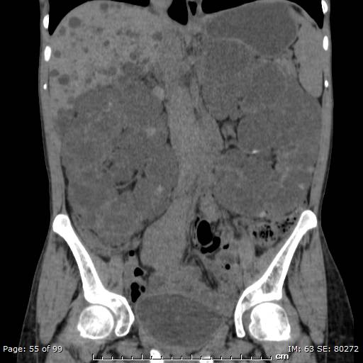 File:Autosomal dominant polycystic kidney disease (Radiopaedia 44122-47684 Coronal 2).jpg