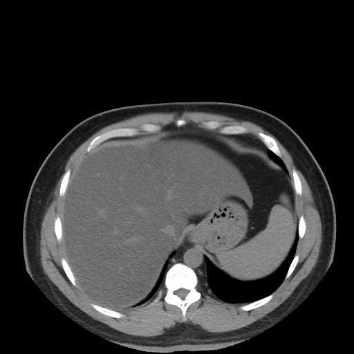 Autosomal dominant polycystic kidney disease (Radiopaedia 50259-55612 Axial non-contrast 18).jpg