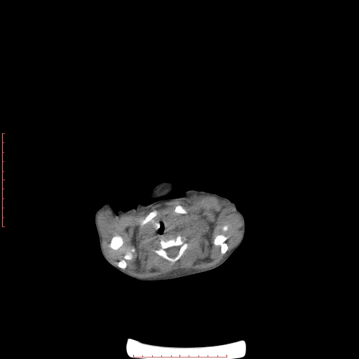 Autosomal recessive polycystic kidney disease associated with Caroli disease (Radiopaedia 61932-69984 Axial non-contrast 5).jpg