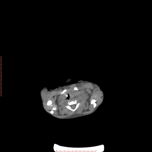 Autosomal recessive polycystic kidney disease associated with Caroli disease (Radiopaedia 61932-69984 Axial non-contrast 6).jpg
