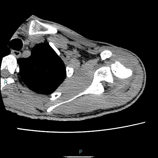 Avascular necrosis after fracture dislocations of the proximal humerus (Radiopaedia 88078-104653 D 30).jpg