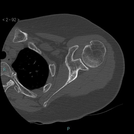 Avascular necrosis of the shoulder - Cruess stage I (Radiopaedia 77674-89887 Axial bone window 23).jpg