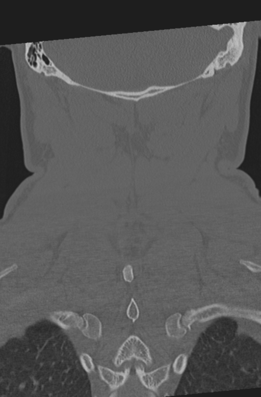 Axis peg fracture (type 3) and atlas lateral mass (type 4) fracture (Radiopaedia 37474-39324 Coronal bone window 51).png