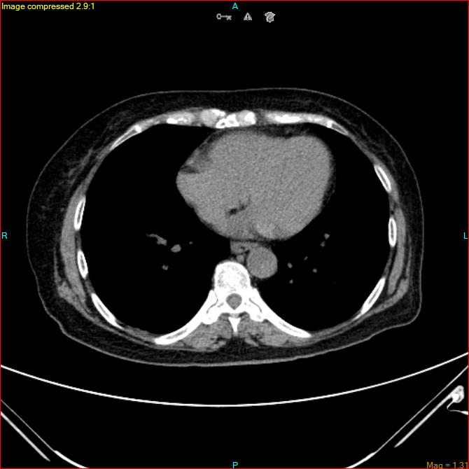 Azygos vein aneurysm (Radiopaedia 77824-90130 A 40).jpg