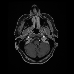 Balo concentric sclerosis (Radiopaedia 53875-59982 Axial LAVA C+ 43).jpg